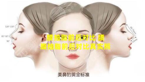 腰抽脂前后对比 腰腹抽脂前后对比真实照
